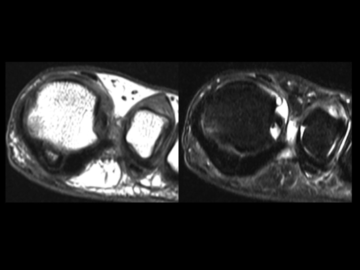 Figure 2 for case fibular sesamoid of metatarsal head ( RID2990 )
